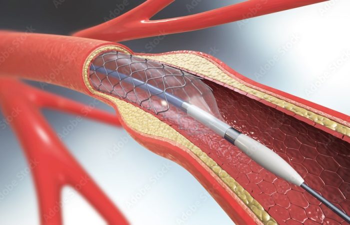 vascular surgery